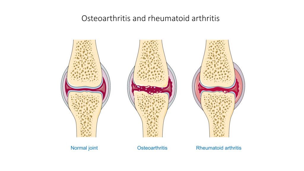 O que é artrite reumatóide e outras poliartropatias inflamatórias?