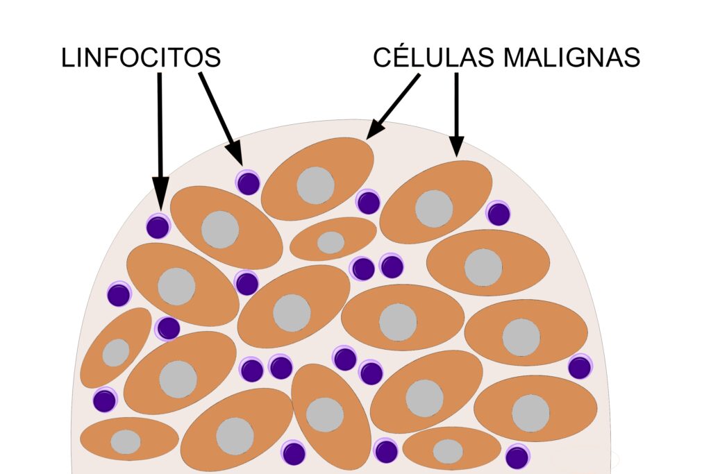 O que é neoplasia maligna do colo do útero?