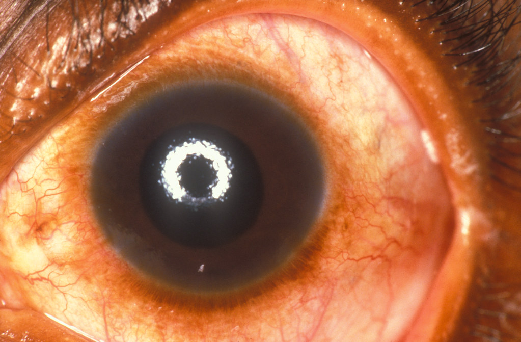 O que é glaucoma?